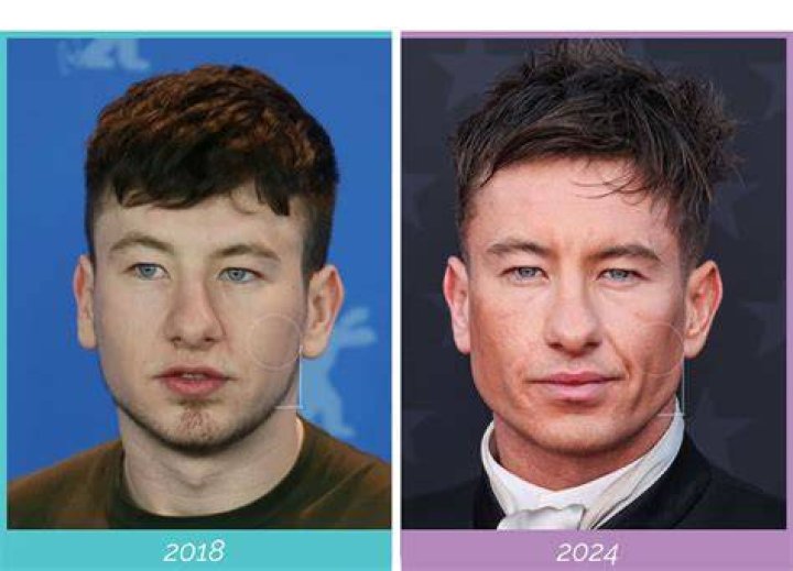 Barry Keoghan’s Plastic Surgery plastic surgery for jaw reconstruction