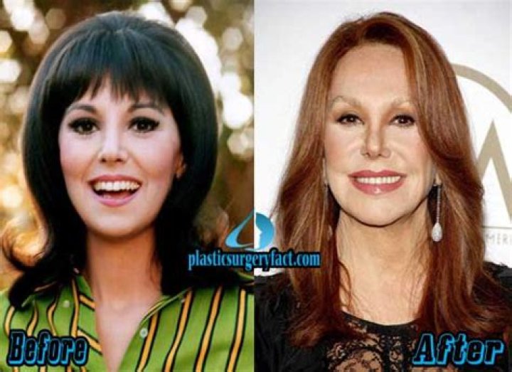 Marlo Thomas Plastic surgery for 76 year old!