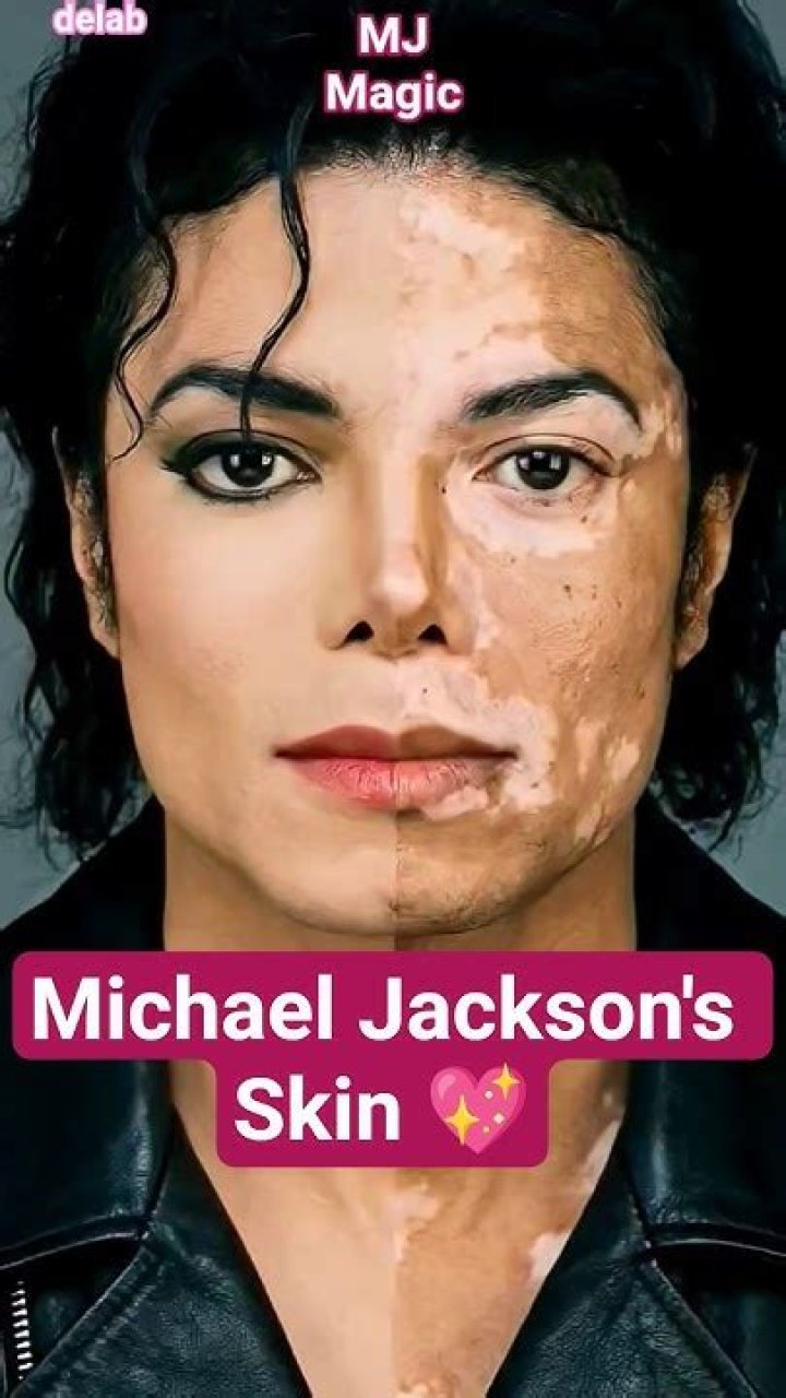 Michael Jackson’s Skin Condition